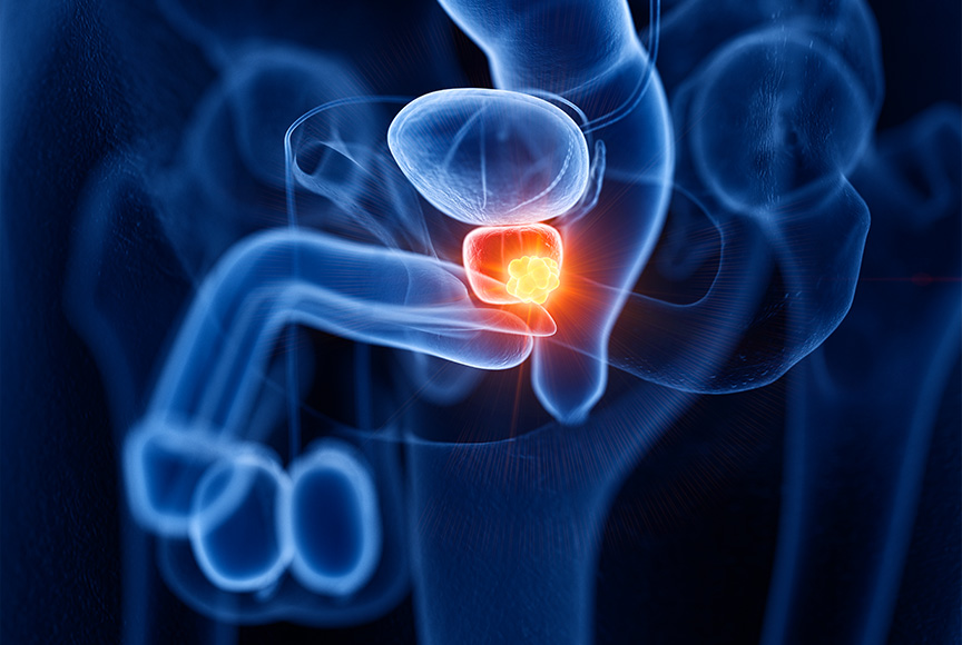 biopsies prostatiques