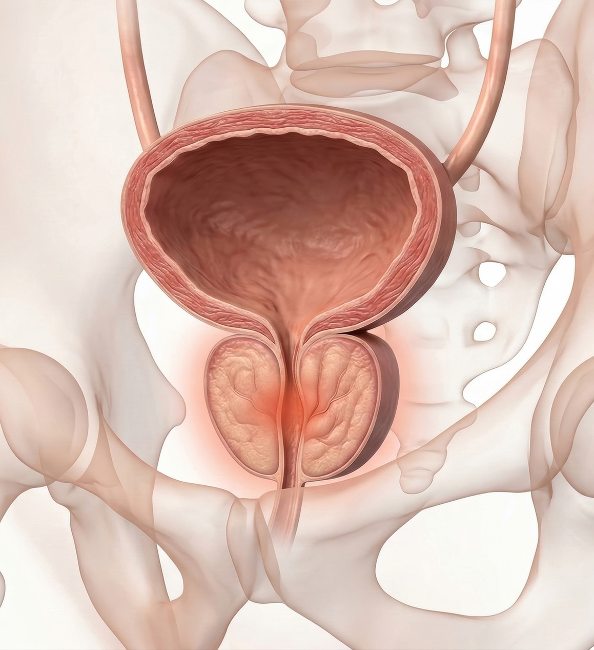Image illustrative d'un adénome de la prostate