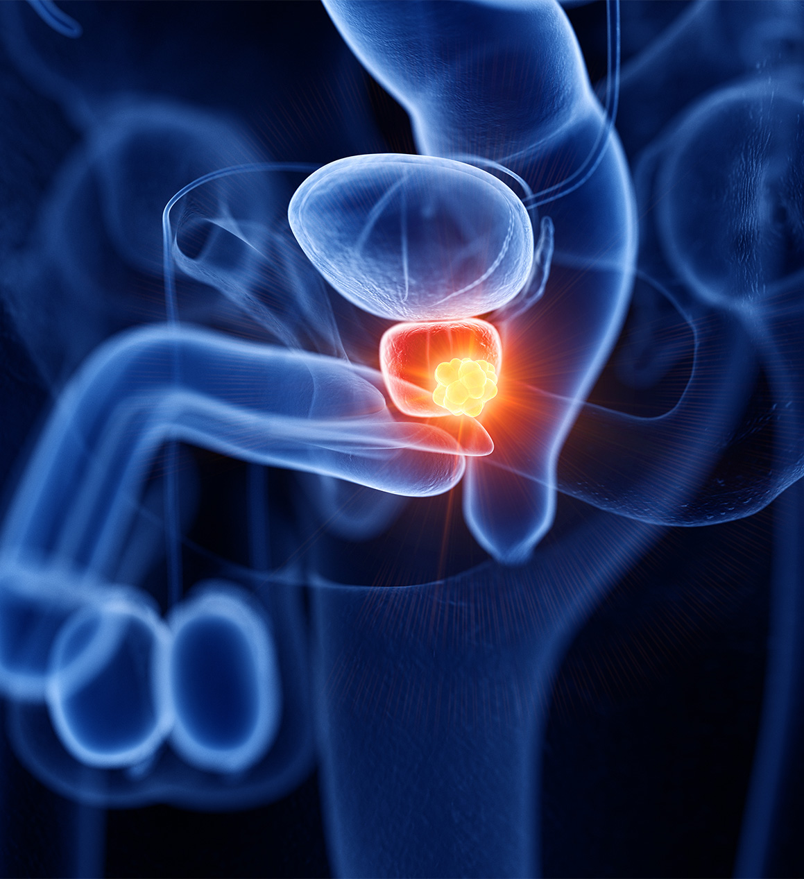 Cancer de la prostate : symptômes, diagnostic et traitements
