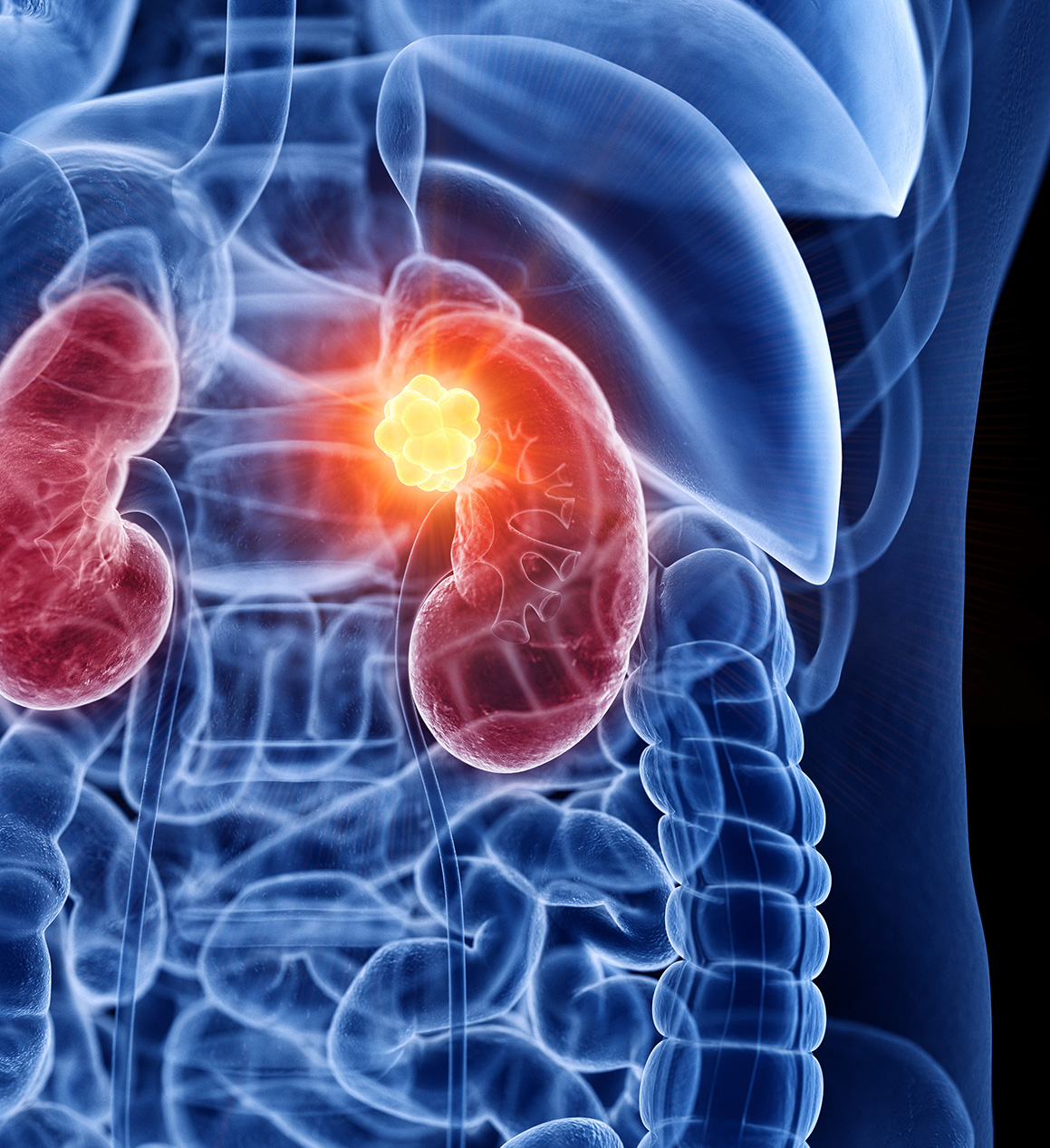 Cancer du rein : symptômes, diagnostic et traitements