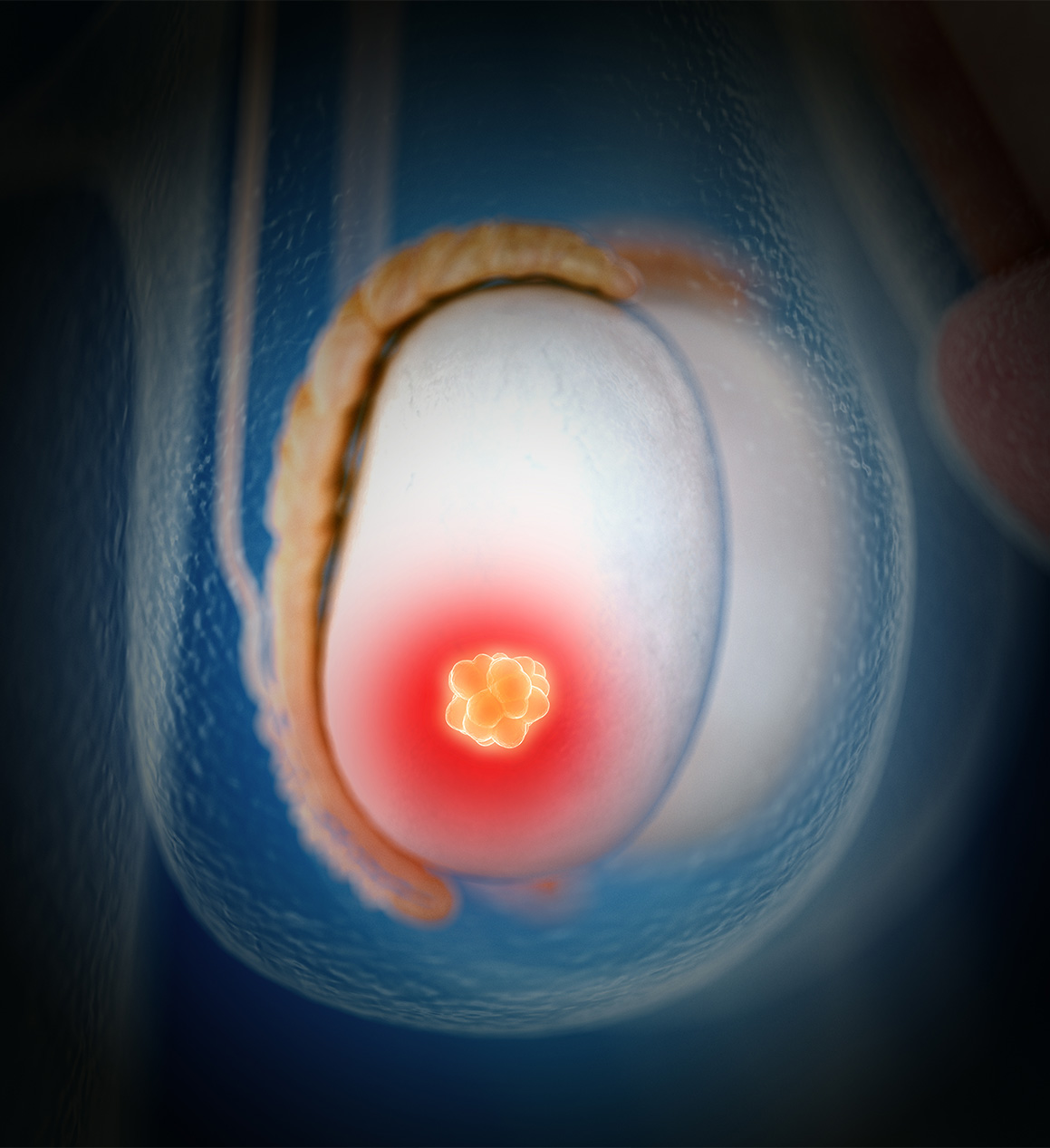 cancer testicule