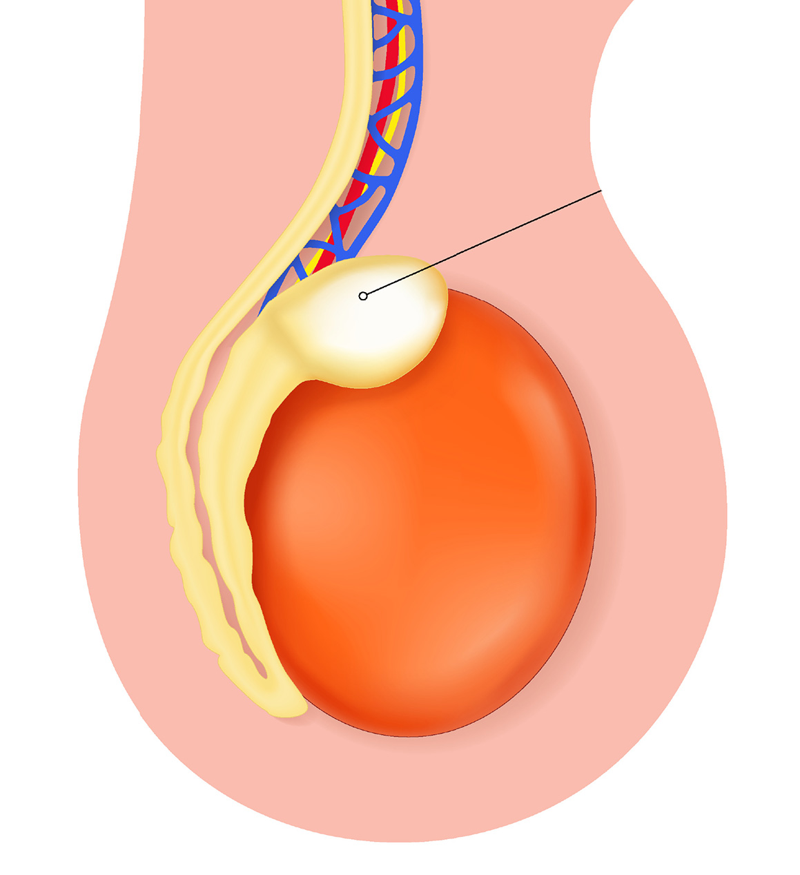 Kyste de l’épididyme ou du cordon spermatique : symptômes, diagnostic et traitements