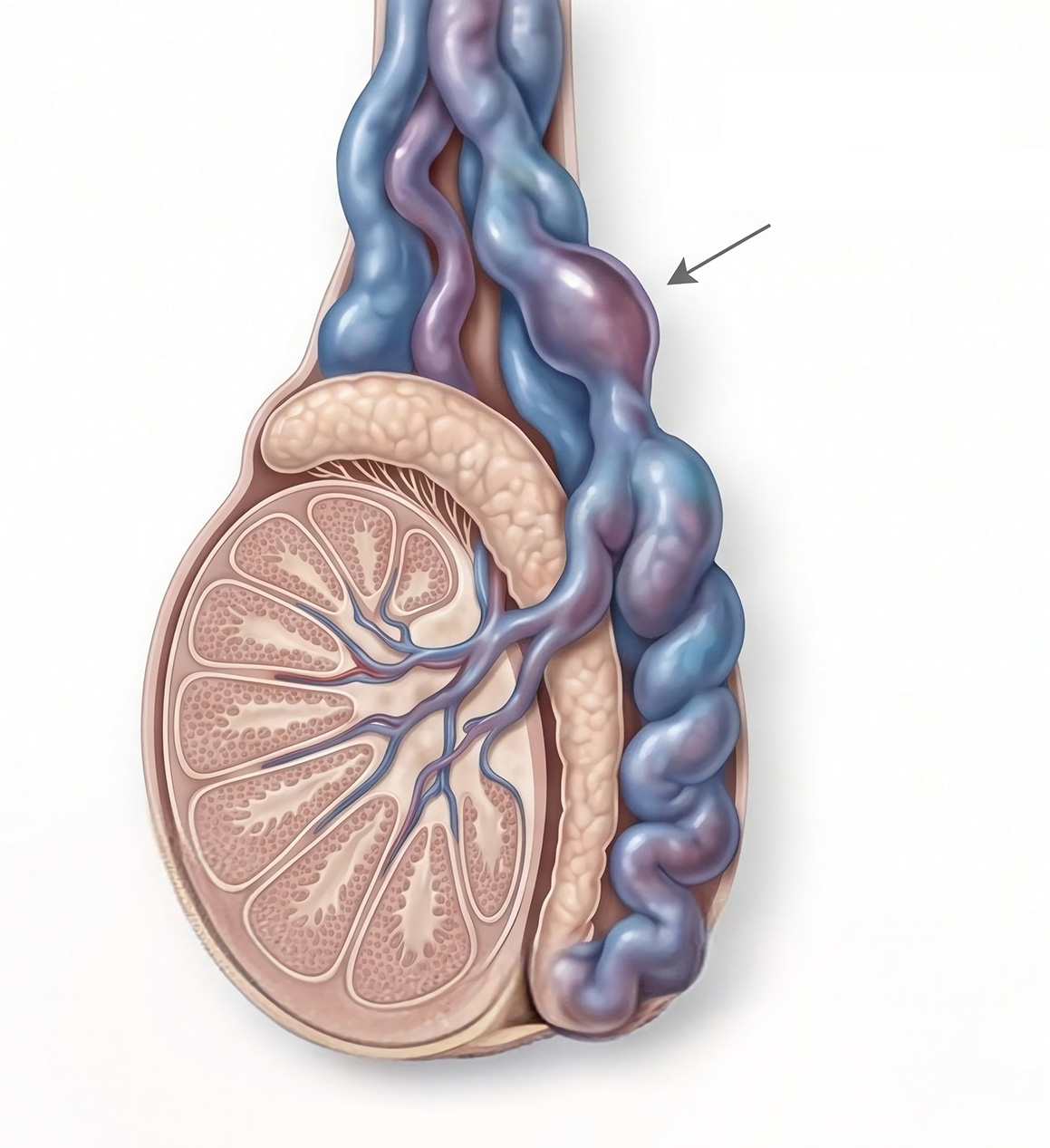 Varicocèle : symptômes, diagnostic et traitements
