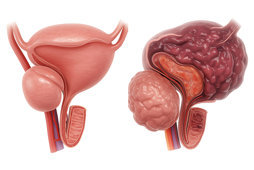 Adenome prostate
