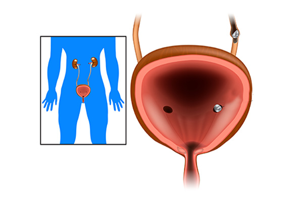 Calcul urinaire