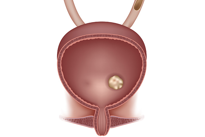 Sonde double J | Uropôle - Urologie Médipôle Lyon