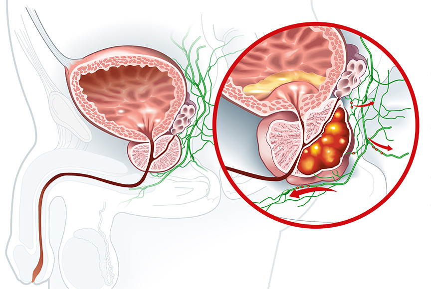 Cancer prostate