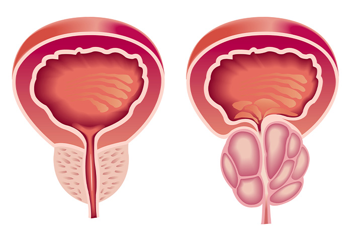 holep adenome prostate