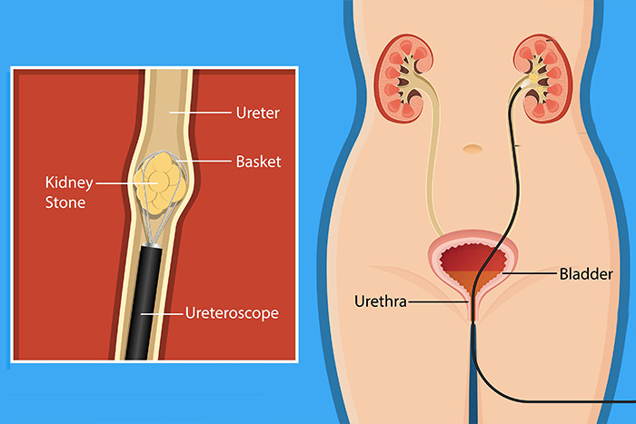 lithiases ureterales