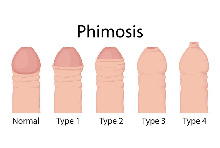 Phimosis